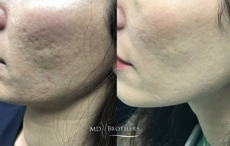 Acne-BA-768x487
