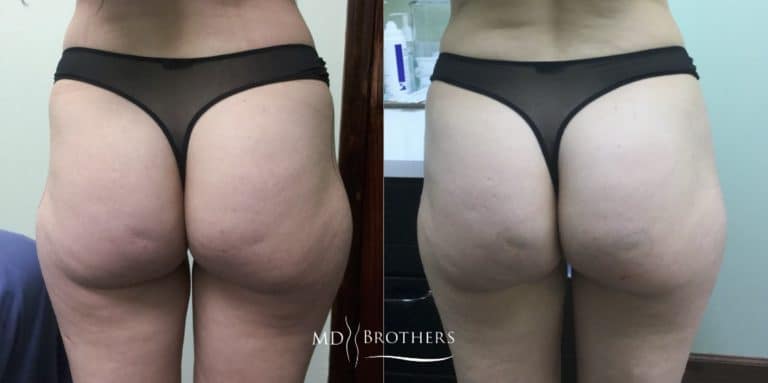 buttLift1-768x383 (1)