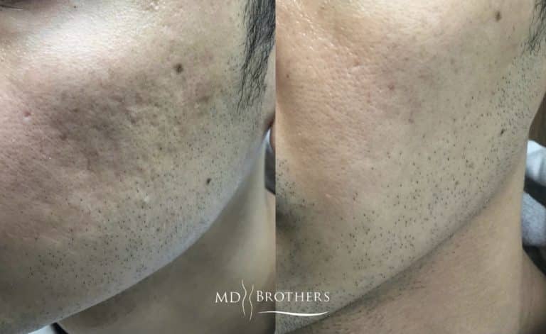 Before and After Image: Acne and Acne Scar Reduction - left-front-oblique