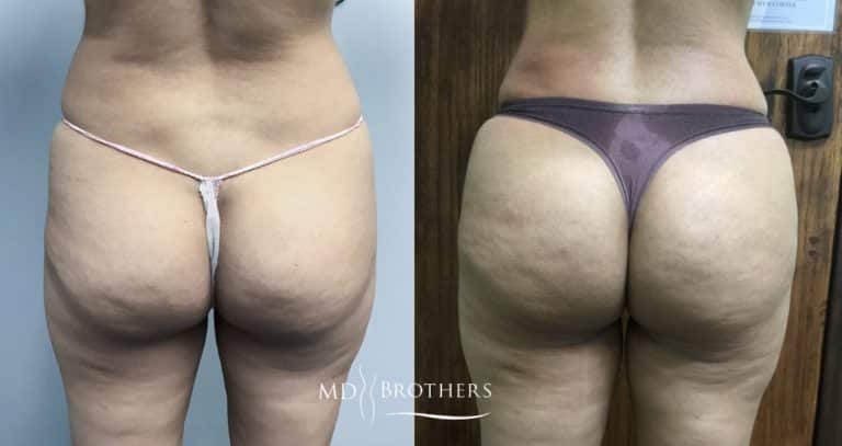 Before and After Image: Brazilian Butt Lift - back