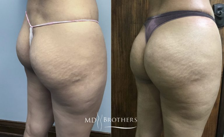 Before and After Image: Brazilian Butt Lift - right-back-oblique
