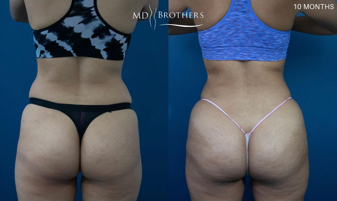 Before and After Image: Brazilian Butt Lift - back