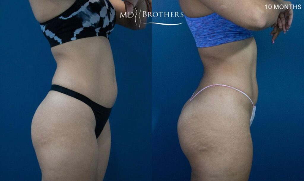 Before and After Image: Brazilian Butt Lift - right-side