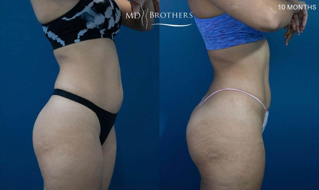 Before and After Image: Brazilian Butt Lift - right-side