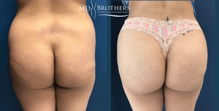 Before and After Image: Brazilian Butt Lift - back