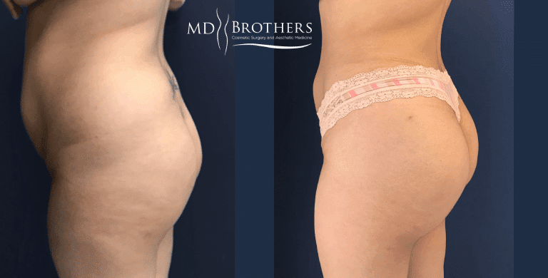 Before and After Image: Brazilian Butt Lift - left-side