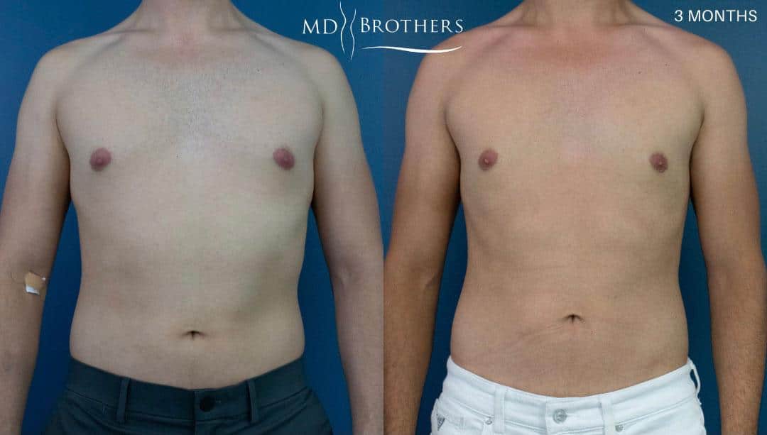 Before and After Image: Chest Liposuction - front