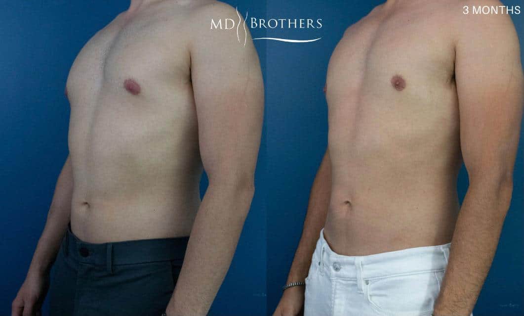Before and After Image: Chest Liposuction - left-front-oblique