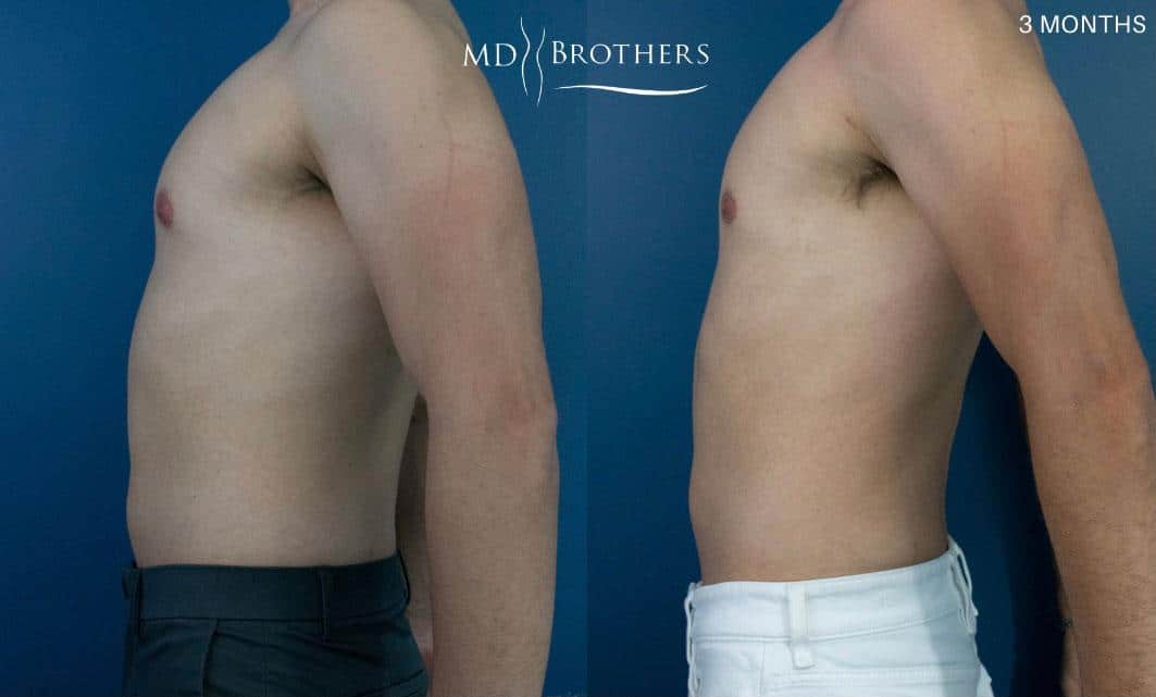 Before and After Image: Chest Liposuction - left-side