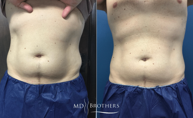 Before and After Image: CoolSculpting - front