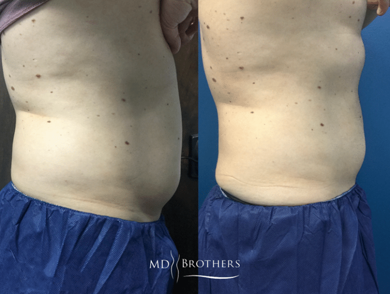 Before and After Image: CoolSculpting - right-side