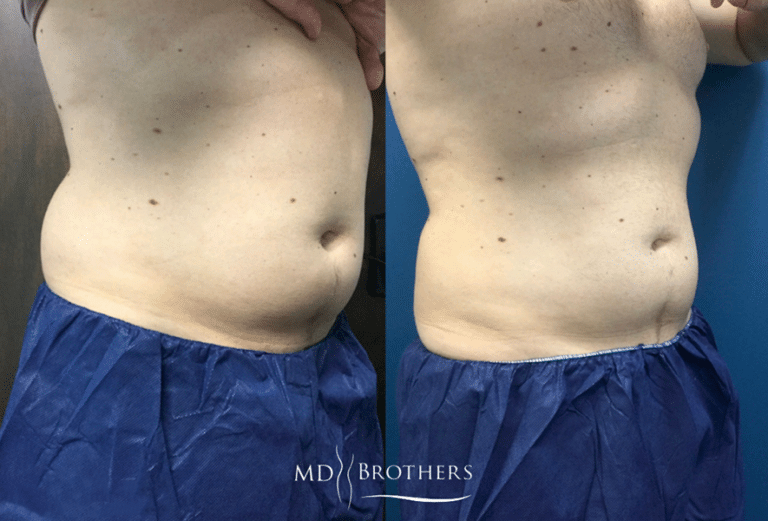 Before and After Image: CoolSculpting - right-front-oblique