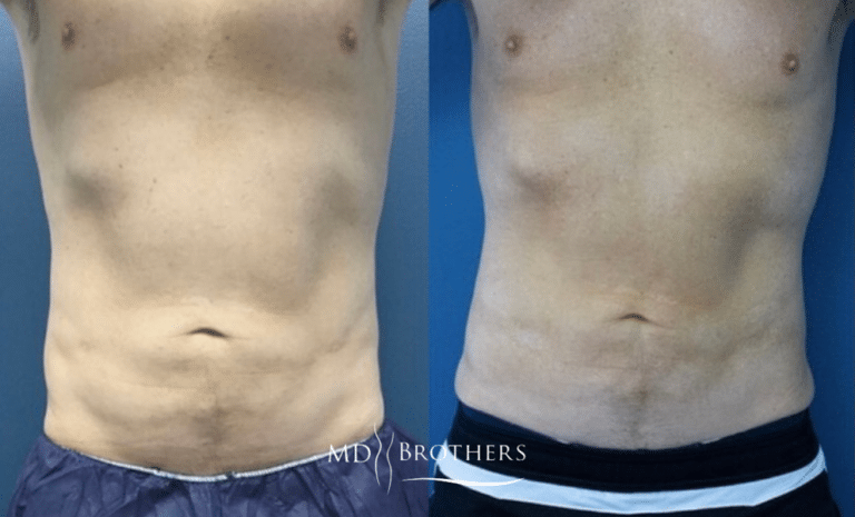 Before and After Image: CoolSculpting - front