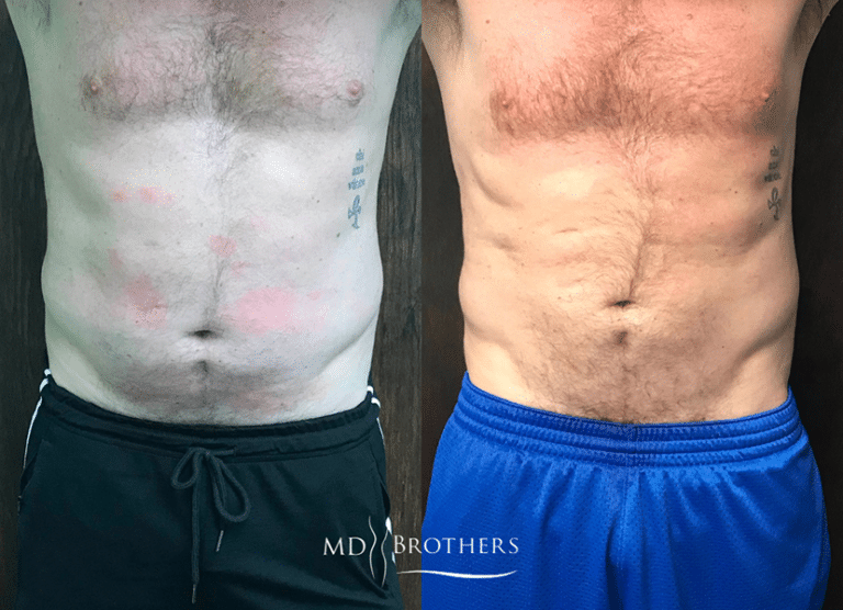 Before and After Image: CoolSculpting - front