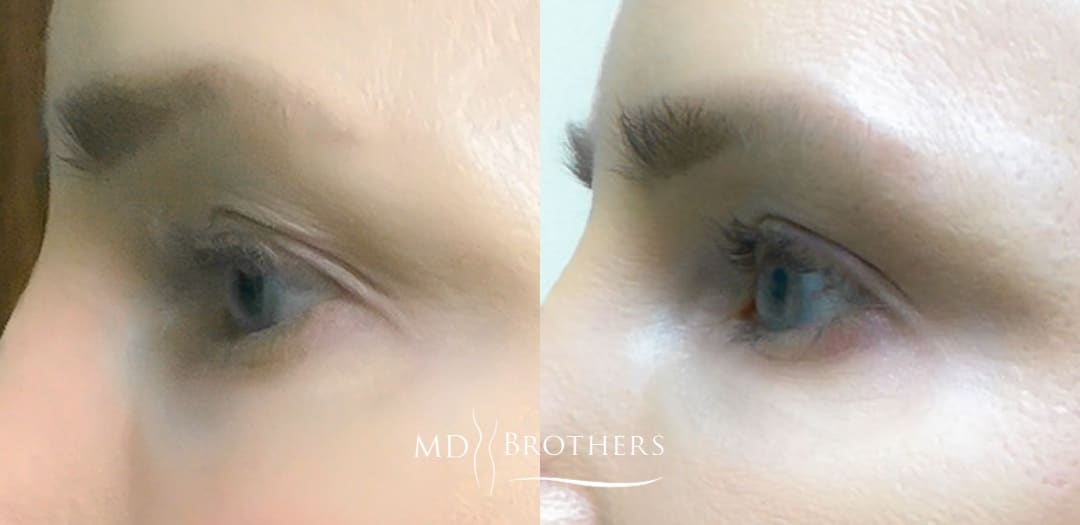 Before and After Image: Eye Rejuvenation - left-side