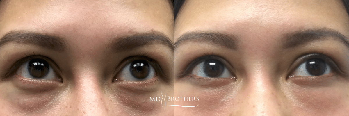 Before and After Image: Eye Rejuvenation - front