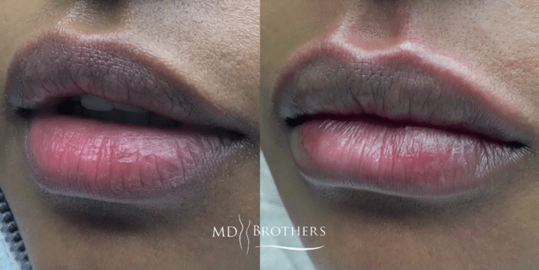 Before and After Image: Lip Filler - left-front-oblique
