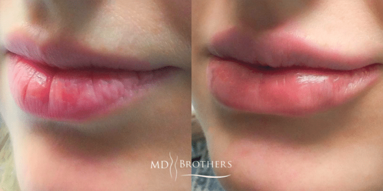 Before and After Image: Lip Filler - left-front-oblique