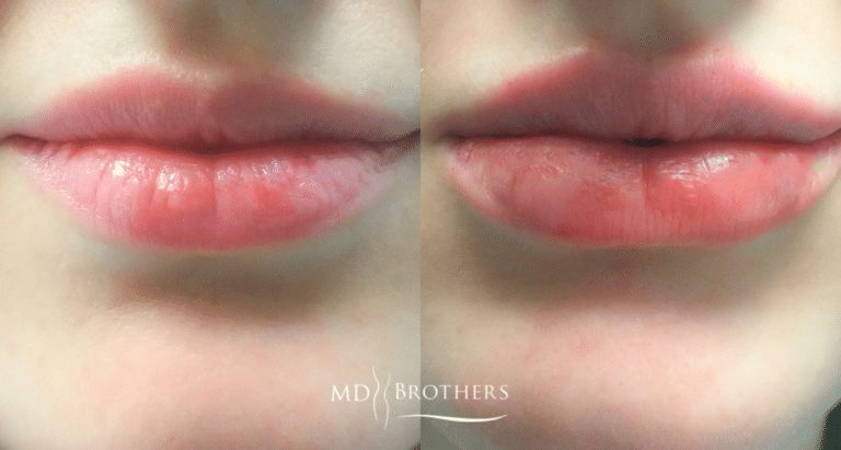 Before and After Image: Lip Filler - front