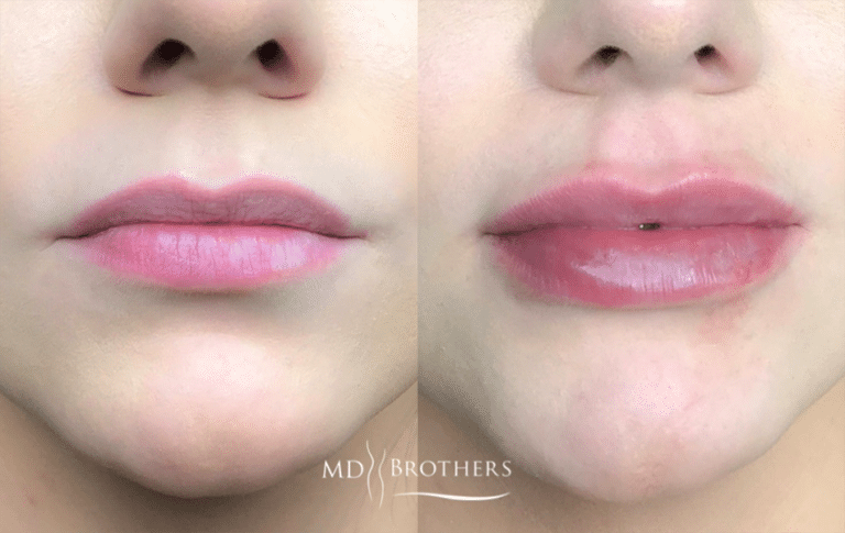 Before and After Image: Lip Filler - front