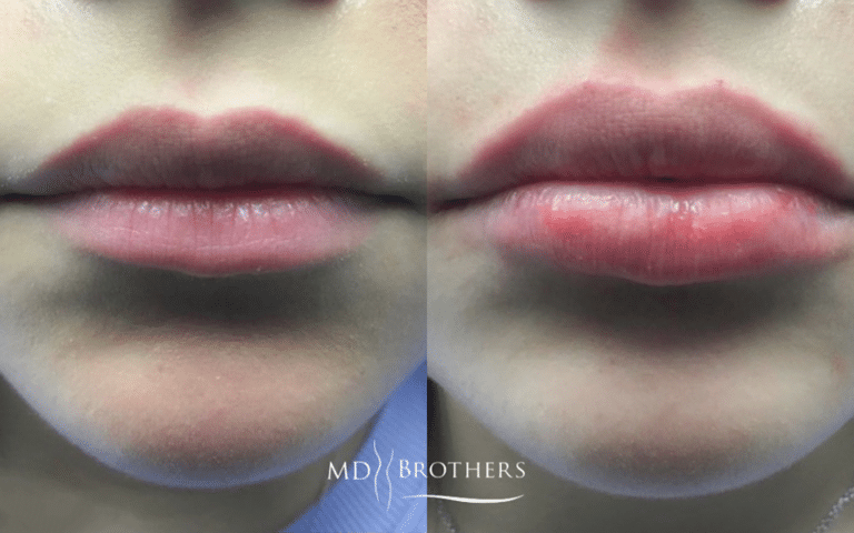 Before and After Image: Lip Filler - front