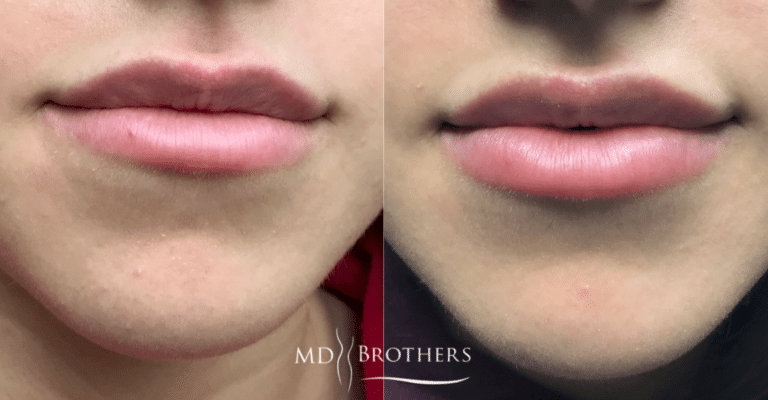 Before and After Image: Lip Filler - front