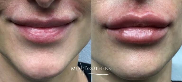 Before and After Image: Lip Filler - front