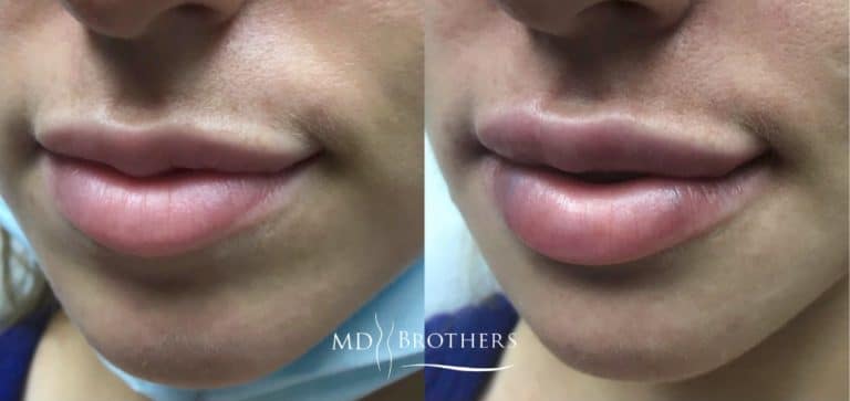Before and After Image: Lip Filler - front