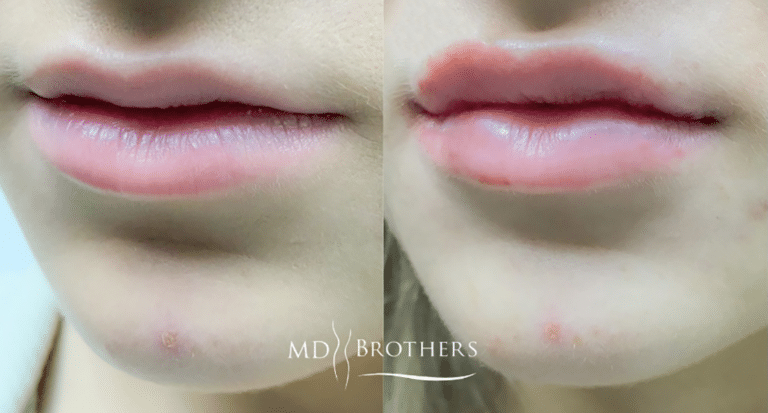 Before and After Image: Lip Filler - left-front-oblique