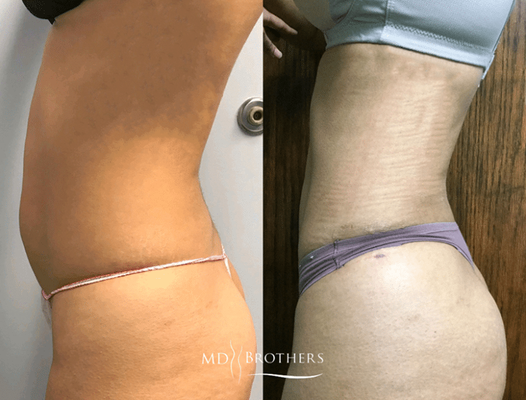 Before and After Image: Liposuction - left-side