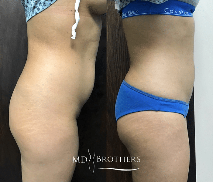 Before and After Image: Liposuction - right-side