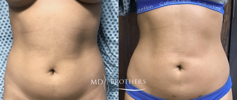 Before and After Image: Liposuction - front