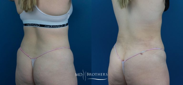 Before and After Image: Liposuction - right-back-oblique