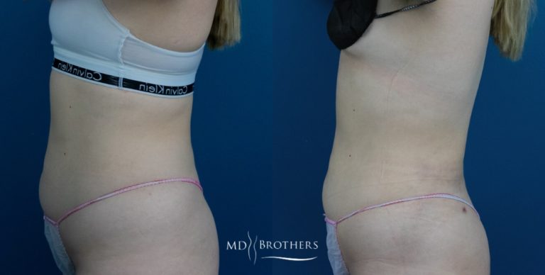 Before and After Image: Liposuction - left-side