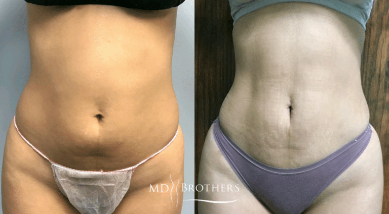 Before and After Image: Liposuction - front