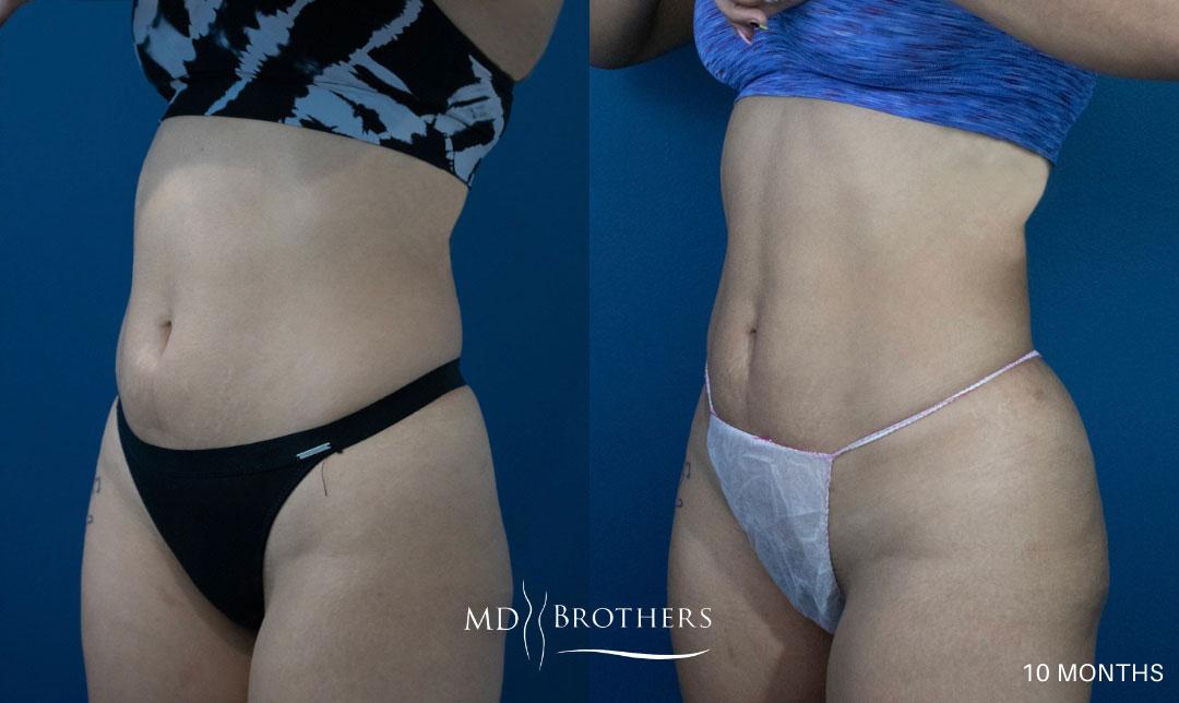 Before and After Image: Liposuction - left-front-oblique
