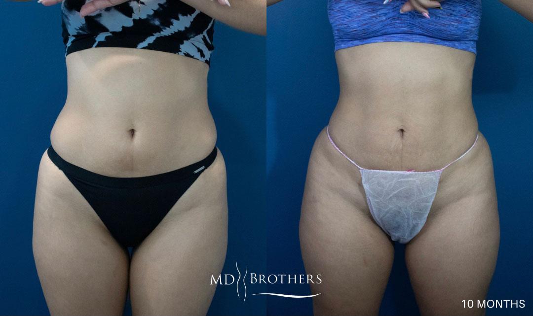 Before and After Image: Liposuction - front