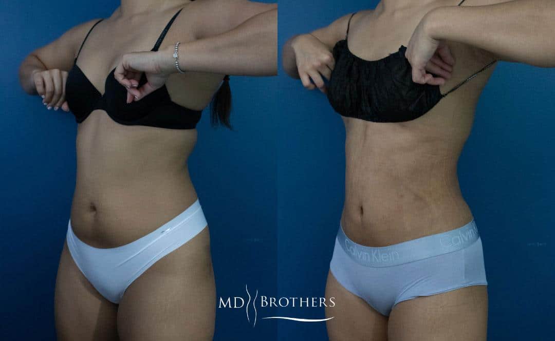 Before and After Image: Liposuction - left-front-oblique