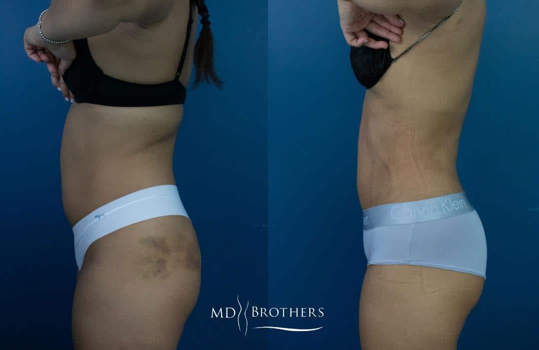 Before and After Image: Liposuction - left-side