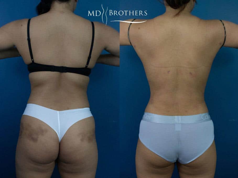 Before and After Image: Liposuction - back