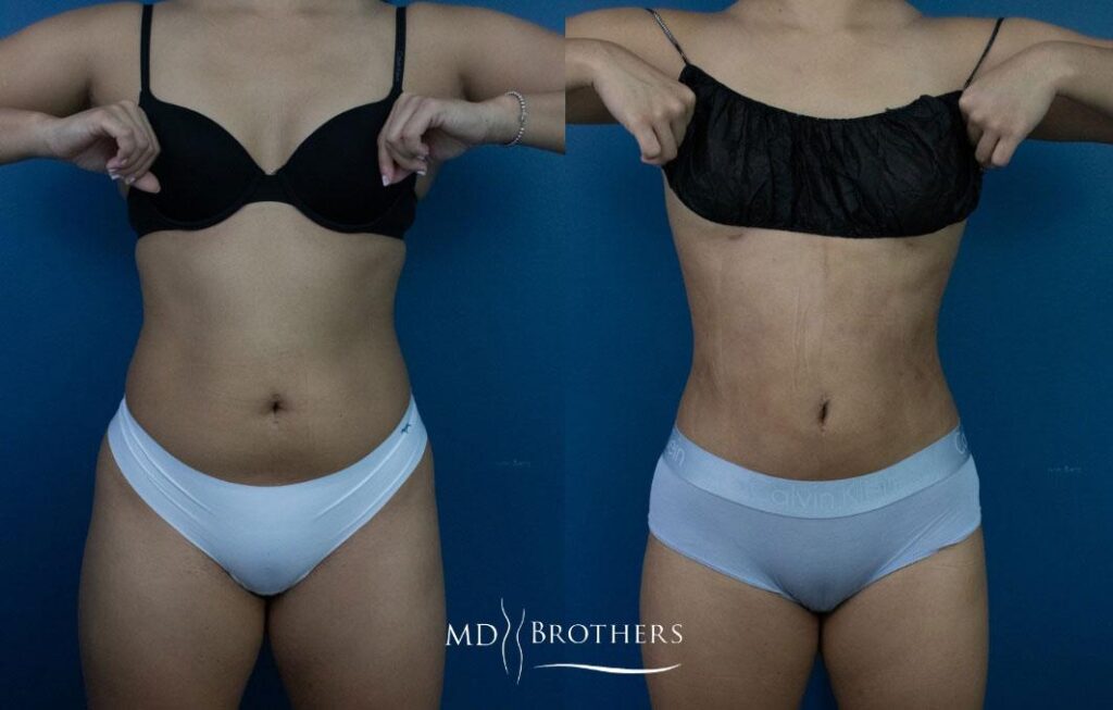 Before and After Image: Liposuction - front