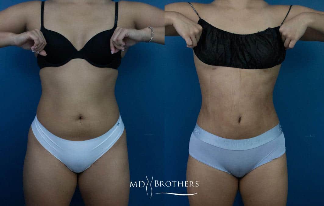 Before and After Image: Liposuction - front