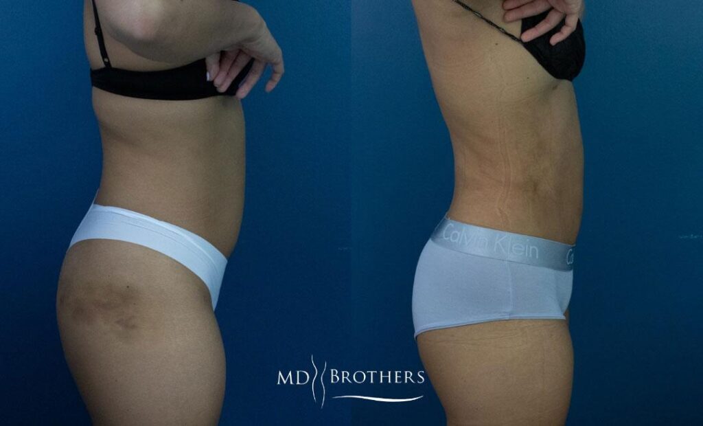 Before and After Image: Liposuction - right-side
