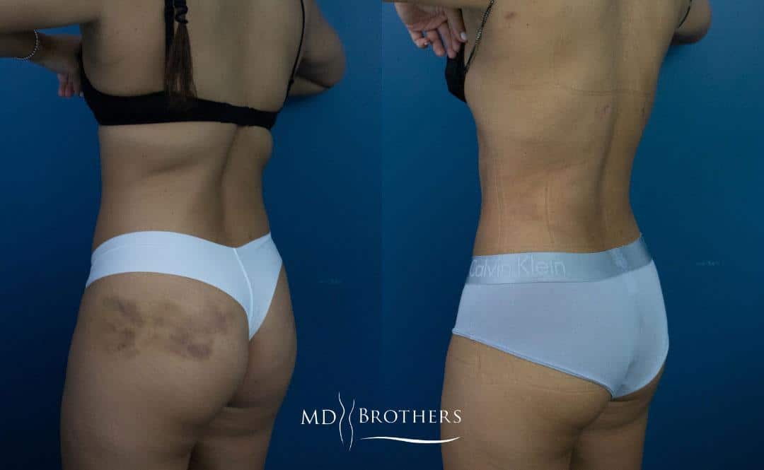 Before and After Image: Liposuction - left-back-oblique