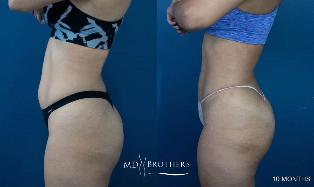 Before and After Image: Liposuction - left-side