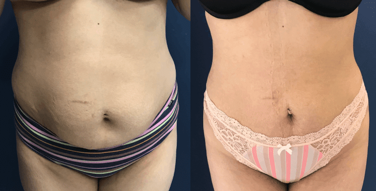 Before and After Image: Liposuction - front