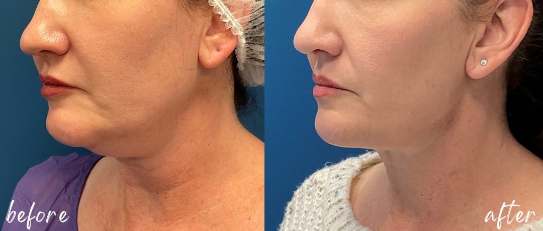 Before and After Image: Lower Face Fat Removal - left-front-oblique
