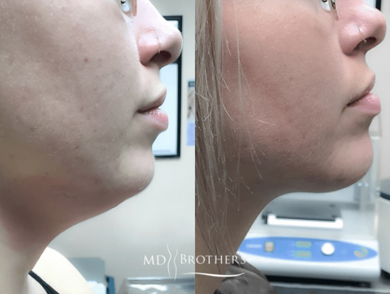 Before and After Image: Lower Face Fat Removal - right-side