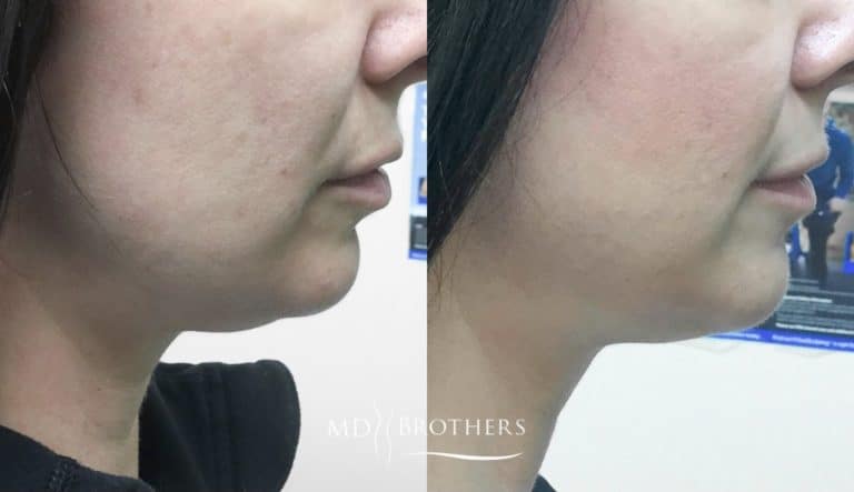 Before and After Image: Lower Face Fat Removal - right-side