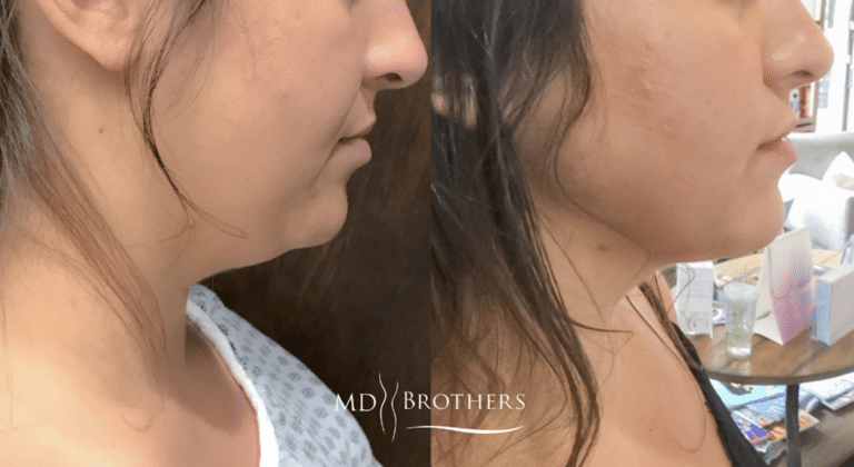 Before and After Image: Lower Face Fat Removal - right-side